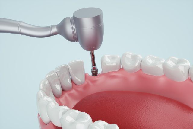 手術のイメージ